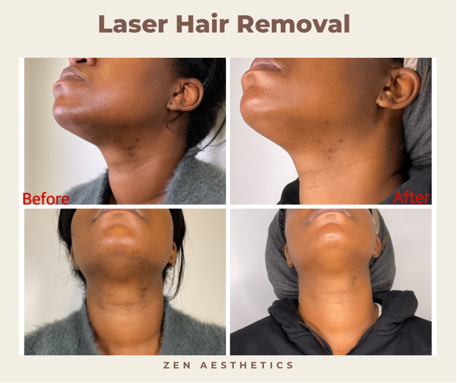 A Timeline For Laser Hair Removal Treatments | Skin Care Kelowna